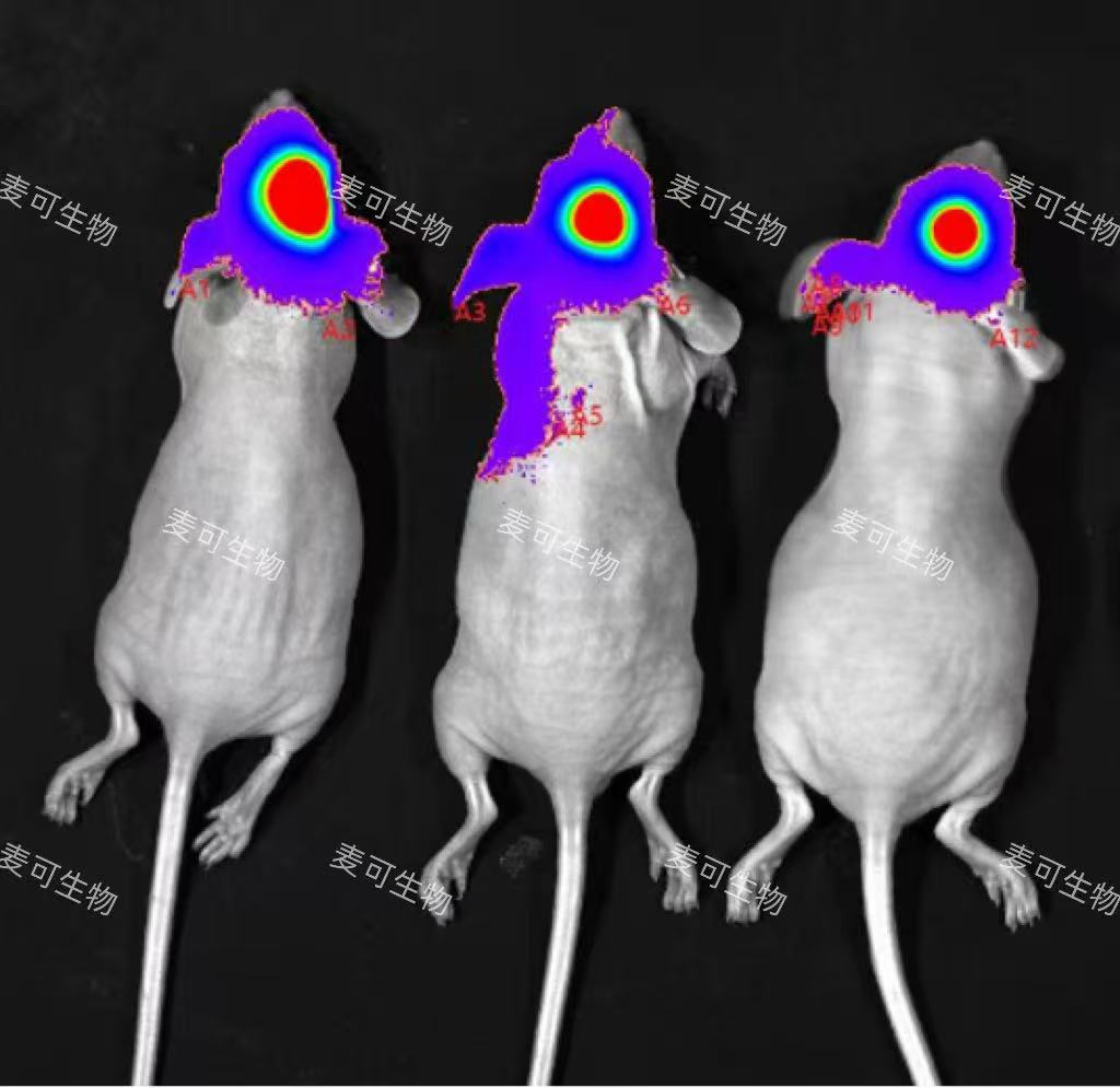 脑胶质瘤