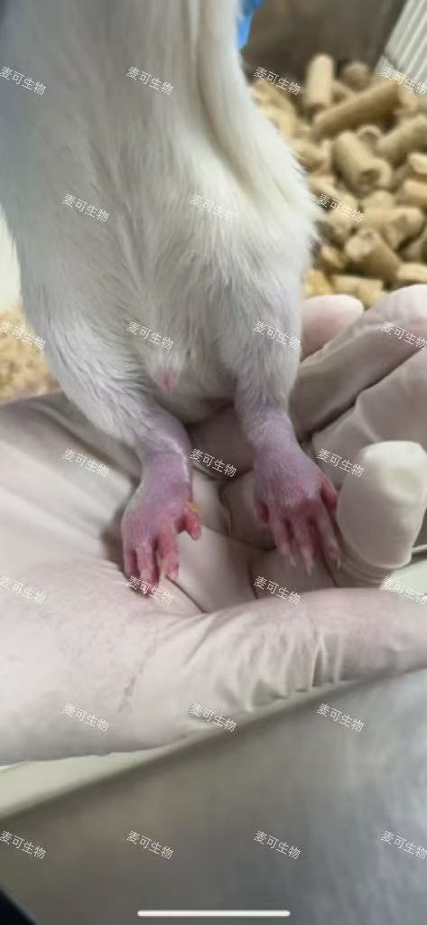 类风湿性关节炎-2